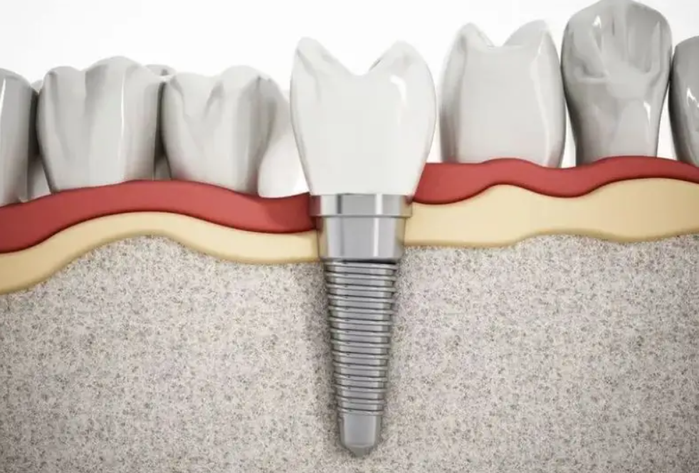 国家医保局称仅一成公众不支持种植牙价格管理，种植牙为何这么贵？