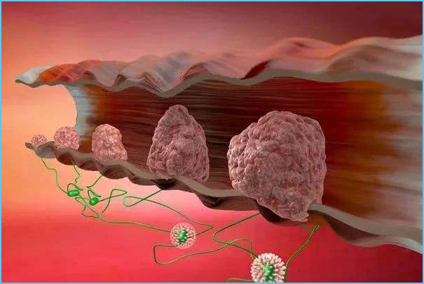 直肠癌早期症状