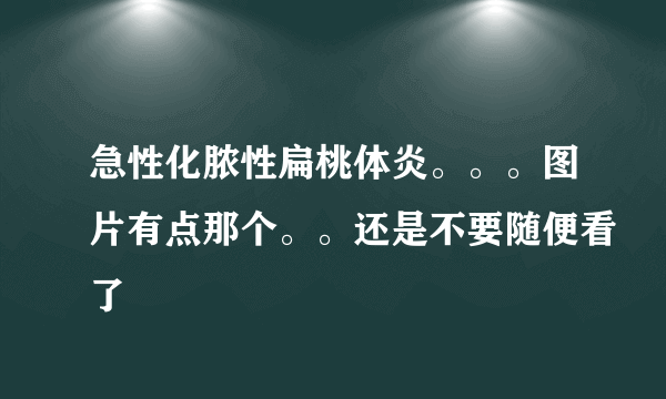 急性化脓性扁桃体炎。。。图片有点那个。。还是不要随便看了