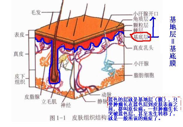 人寿保险所说的原位癌指是什么，有没有什么标准